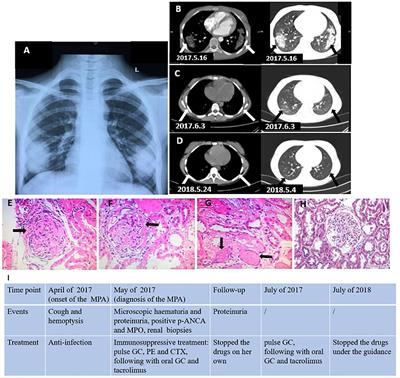 Microscopic polyangiitis presenting with persistent cough and hemoptysis in pediatrics: A case report and review of the literature
